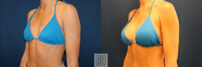 Before & After Breast Augmentation Case 678 Bikini Left Oblique View in Torrance, CA