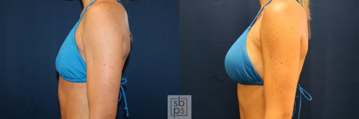 Before & After Breast Augmentation Case 678 Bikini Left View in Torrance, CA