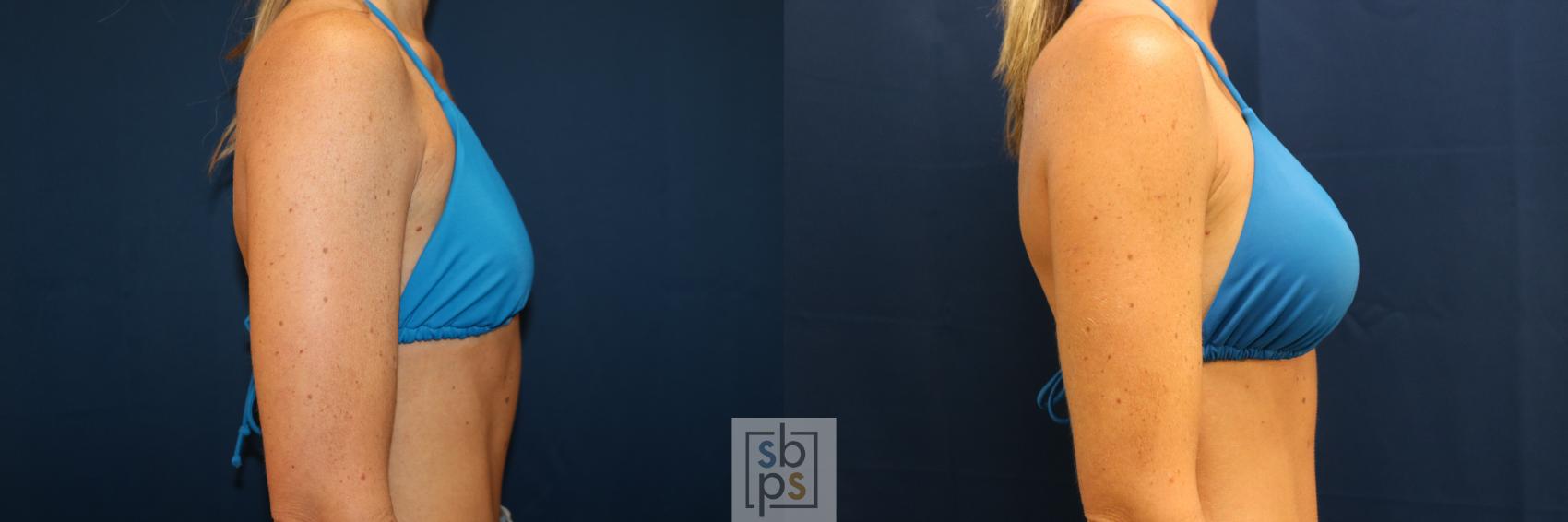 Before & After Breast Augmentation Case 678 Bikini Right View in Torrance & Los Angeles, CA, CA