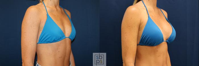 Before & After Breast Augmentation Case 678 Bikini Right Oblique View in Torrance, CA