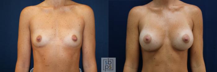 Before & After Breast Augmentation Case 678 Front View in Torrance, CA