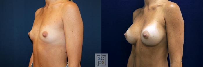 Before & After Breast Augmentation Case 678 Left Oblique View in Torrance, CA