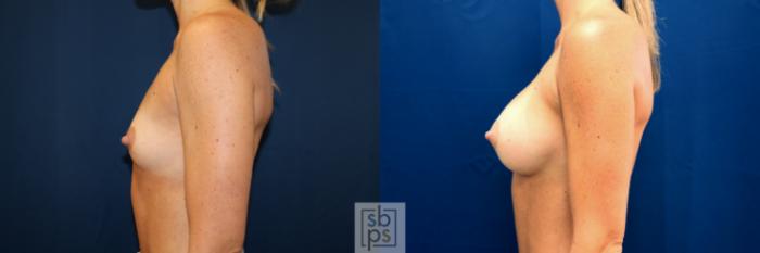 Before & After Breast Augmentation Case 678 Left Side View in Torrance, CA