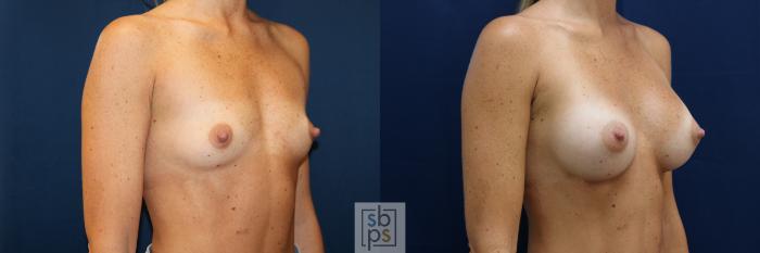 Before & After Breast Augmentation Case 678 Right Oblique View in Torrance, CA