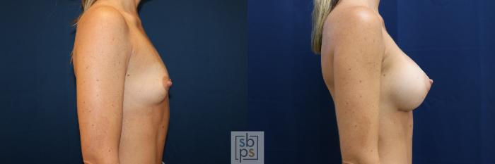 Before & After Breast Augmentation Case 678 Right Side View in Torrance, CA