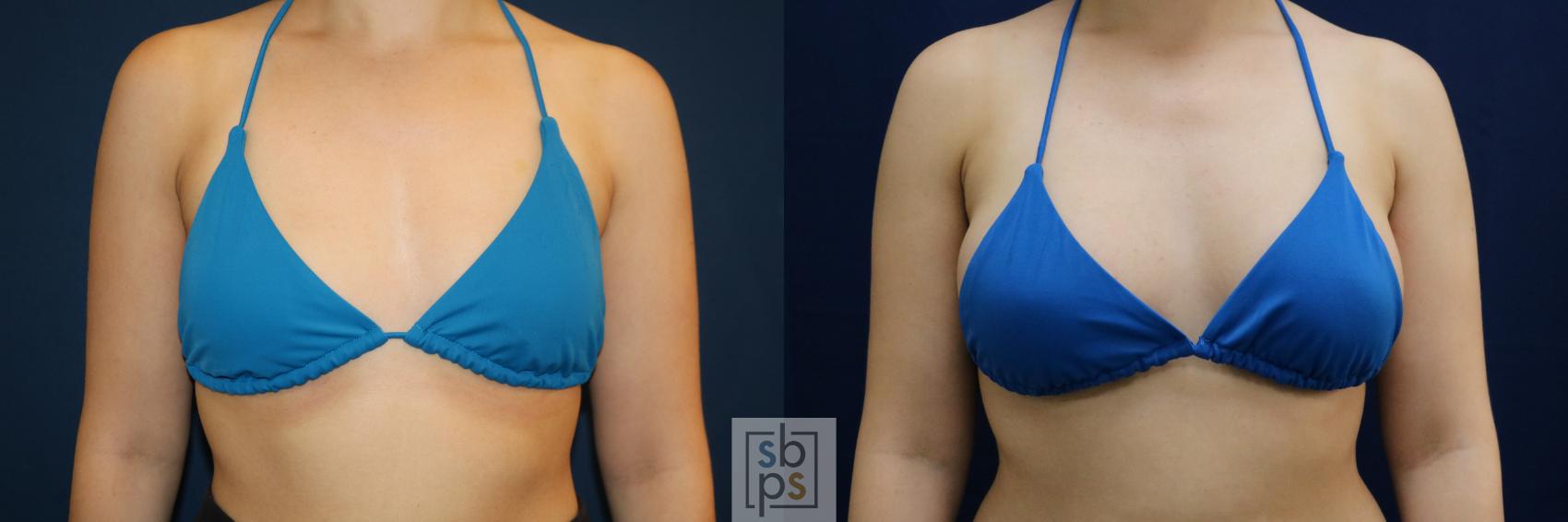 Before & After Breast Augmentation Case 679 Bikini Front View in Torrance & Los Angeles, CA, CA