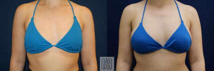 Before & After Breast Augmentation Case 679 Bikini Front View in Torrance, CA