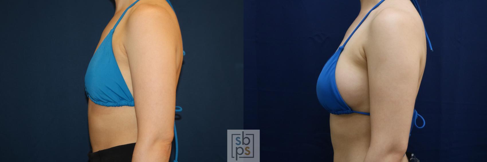 Before & After Breast Augmentation Case 679 Bikini Left View in Torrance & Los Angeles, CA, CA