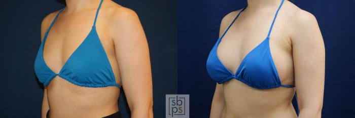 Before & After Breast Augmentation Case 679 Bikini Left Oblique View in Torrance, CA