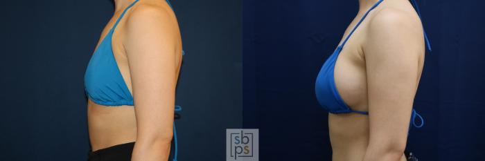 Before & After Breast Augmentation Case 679 Bikini Left View in Torrance, CA