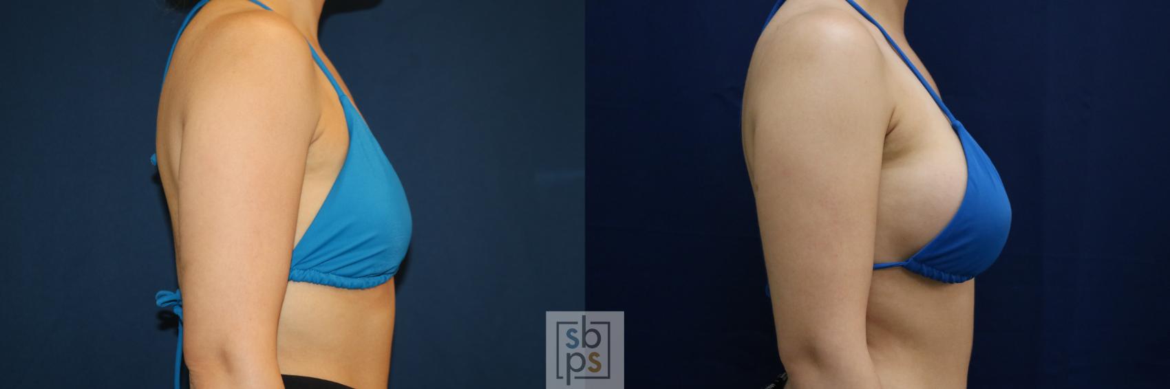Before & After Breast Augmentation Case 679 Bikini Right View in Torrance & Los Angeles, CA, CA