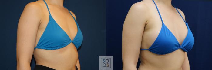 Before & After Breast Augmentation Case 679 Bikini Right Oblique View in Torrance, CA