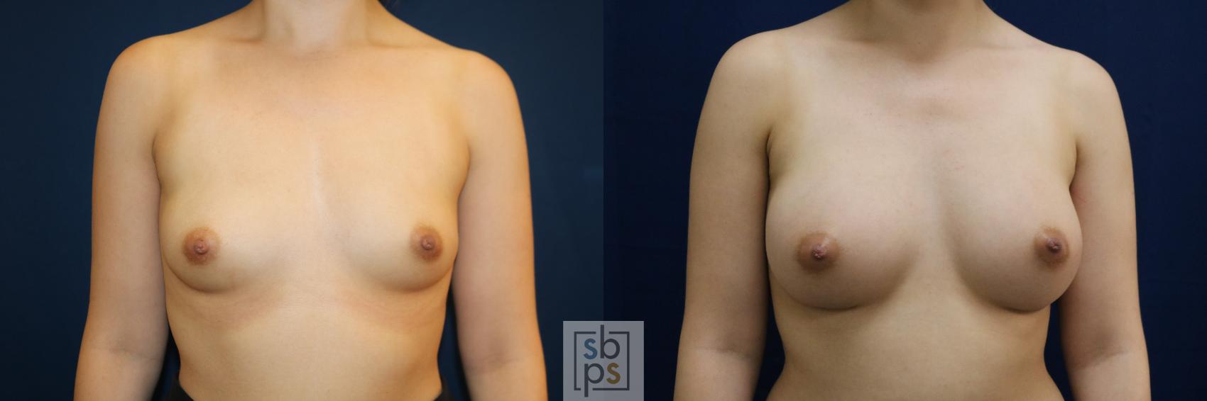 Before & After Breast Augmentation Case 679 Front View in Torrance, CA