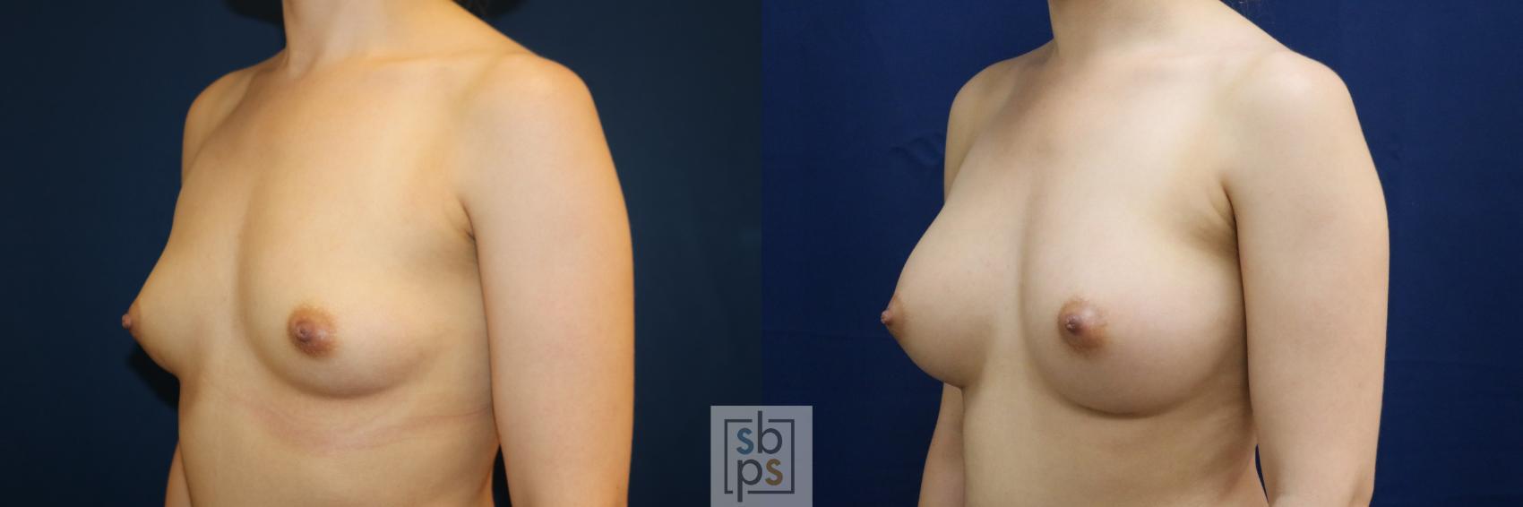 Before & After Breast Augmentation Case 679 Left Oblique View in Torrance & Los Angeles, CA, CA