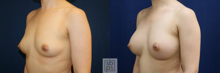 Before & After Breast Augmentation Case 679 Left Oblique View in Torrance, CA