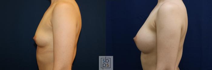 Before & After Breast Augmentation Case 679 Left Side View in Torrance, CA