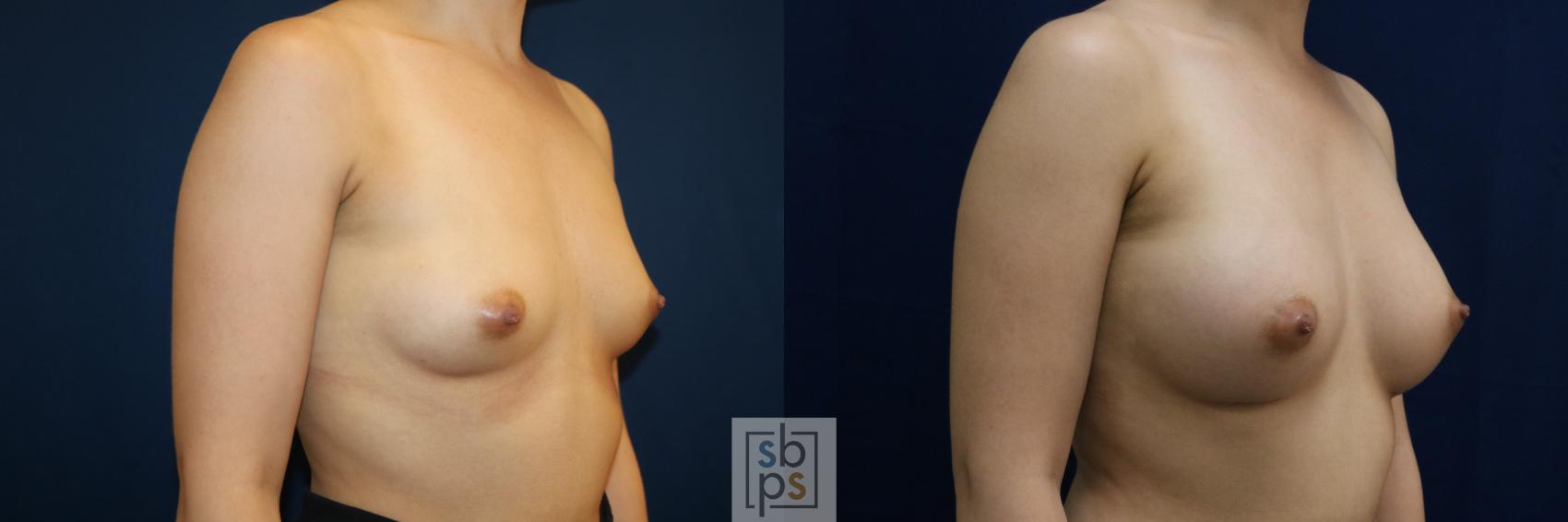 Before & After Breast Augmentation Case 679 Right Oblique View in Torrance & Los Angeles, CA, CA