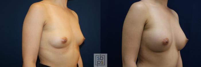 Before & After Breast Augmentation Case 679 Right Oblique View in Torrance, CA