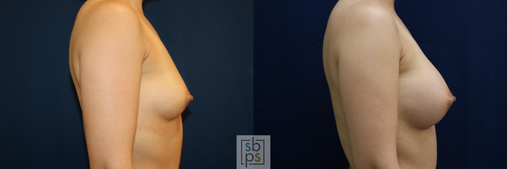 Before & After Breast Augmentation Case 679 Right Side View in Torrance & Los Angeles, CA, CA