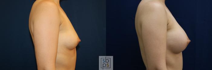 Before & After Breast Augmentation Case 679 Right Side View in Torrance, CA