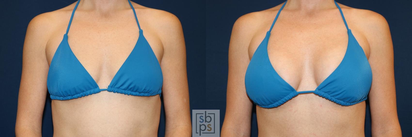 Before & After Breast Augmentation Case 681 Bikini Front View in Torrance & Los Angeles, CA, CA