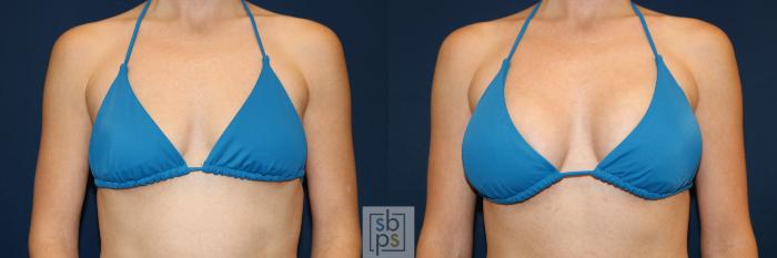 Before & After Breast Augmentation Case 681 Bikini Front View in Torrance, CA