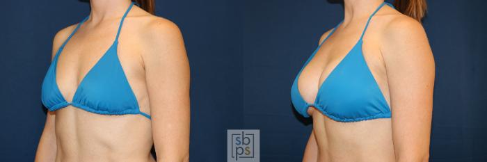 Before & After Breast Augmentation Case 681 Bikini Left Oblique View in Torrance, CA