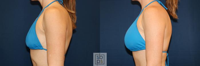 Before & After Breast Augmentation Case 681 Bikini Left View in Torrance, CA