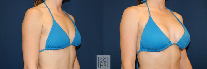 Before & After Breast Augmentation Case 681 Bikini Right Oblique View in Torrance, CA