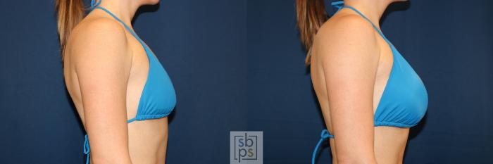 Before & After Breast Augmentation Case 681 Bikini Right View in Torrance, CA