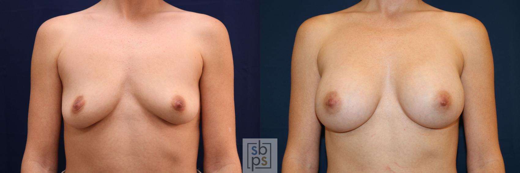 Before & After Breast Augmentation Case 681 Front View in Torrance, CA