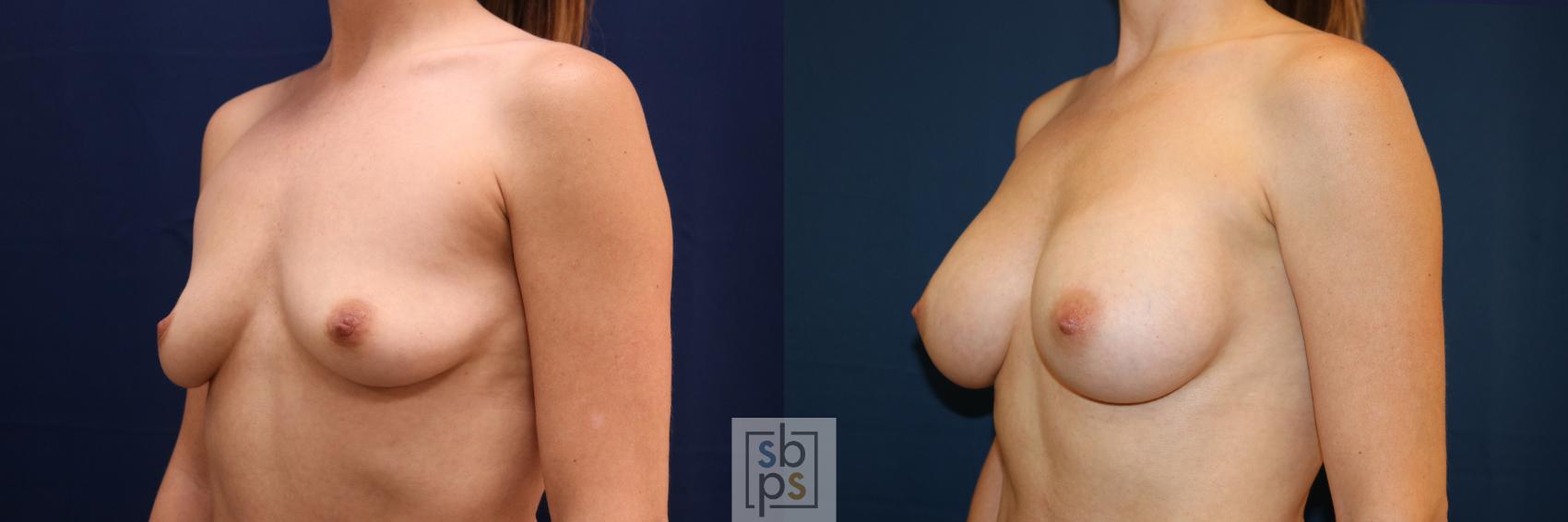 Before & After Breast Augmentation Case 681 Left Oblique View in Torrance & Los Angeles, CA, CA