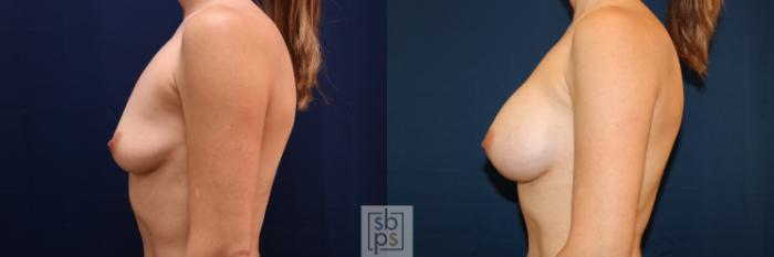Before & After Breast Augmentation Case 681 Left Side View in Torrance, CA