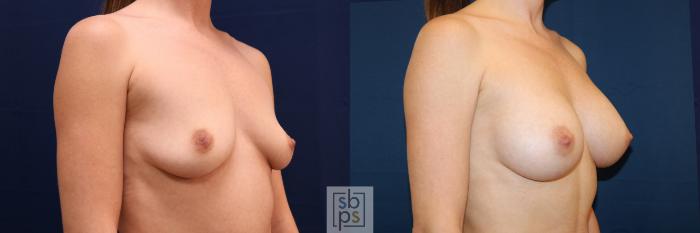 Before & After Breast Augmentation Case 681 Right Oblique View in Torrance, CA