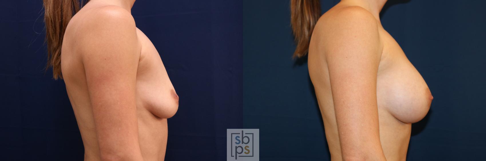 Before & After Breast Augmentation Case 681 Right Side View in Torrance & Los Angeles, CA, CA