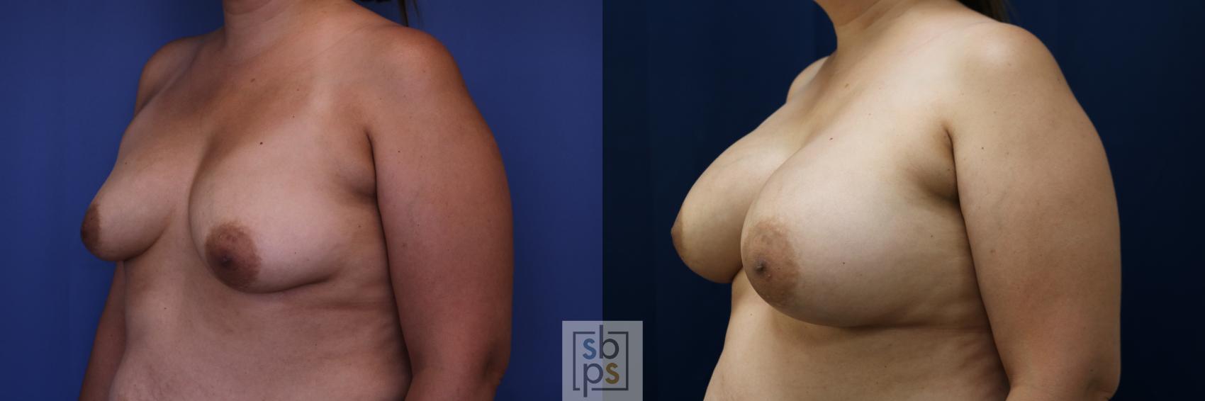 Before & After Breast Lift Case 684 Left Oblique View in Torrance & Los Angeles, CA, CA