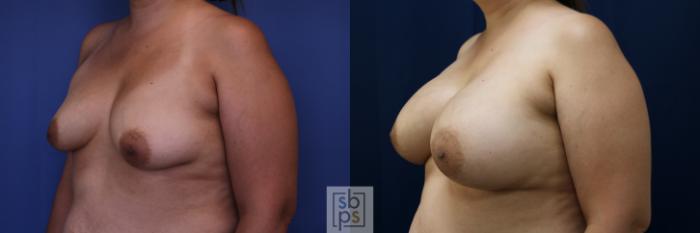 Before & After Breast Lift Case 684 Left Oblique View in Torrance, CA