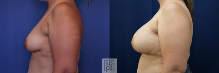 Before & After Breast Lift Case 684 Left Side View in Torrance, CA