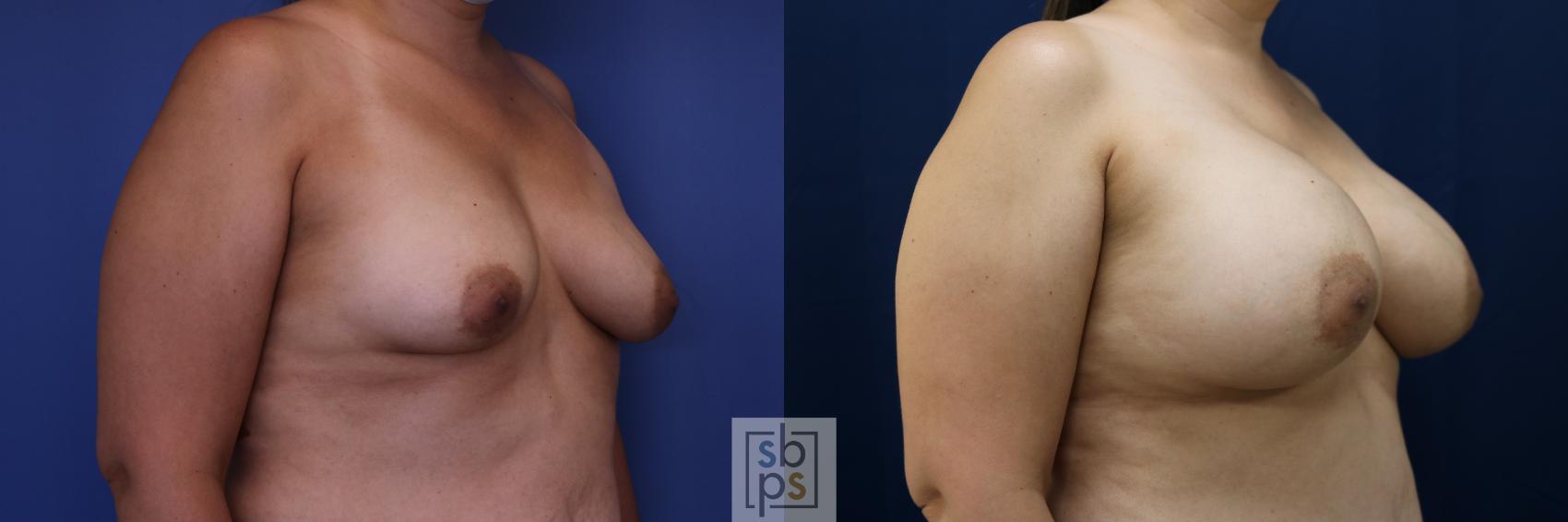 Before & After Breast Lift Case 684 Right Oblique View in Torrance & Los Angeles, CA, CA
