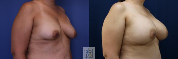 Before & After Breast Augmentation Case 684 Right Oblique View in Torrance, CA