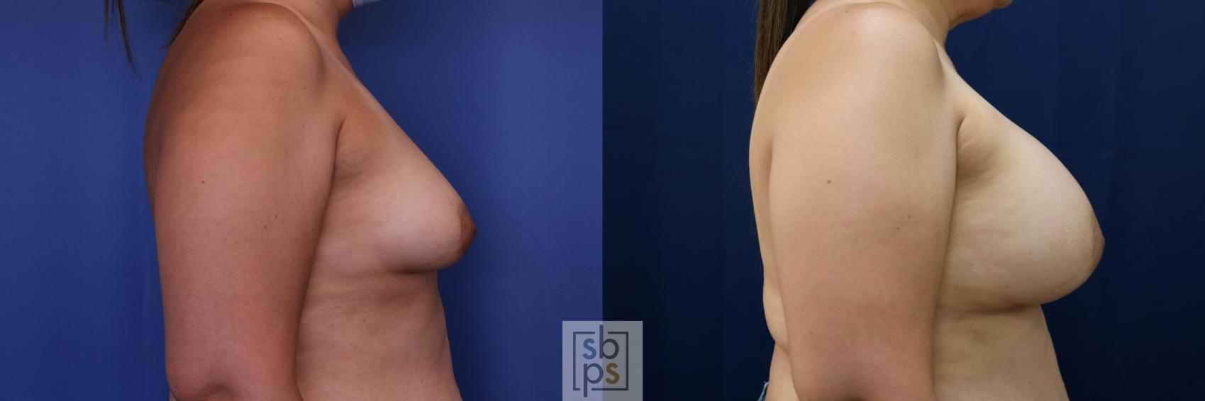 Before & After Breast Lift Case 684 Right Side View in Torrance & Los Angeles, CA, CA