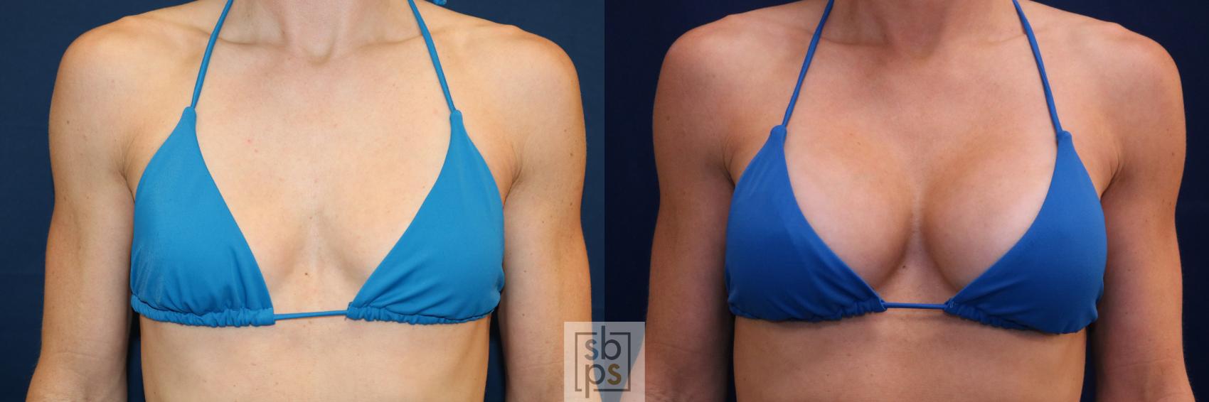 Before & After Breast Augmentation Case 688 Bikini Front View in Torrance & Los Angeles, CA, CA