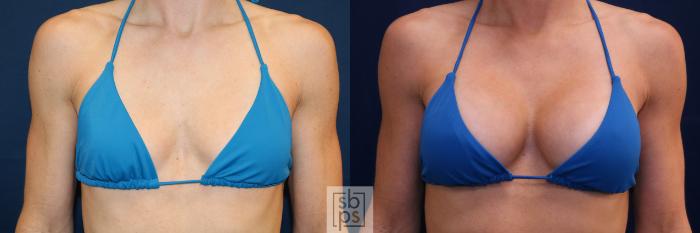 Before & After Breast Augmentation Case 688 Bikini Front View in Torrance, CA