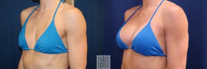 Before & After Breast Augmentation Case 688 Bikini Left Oblique View in Torrance, CA