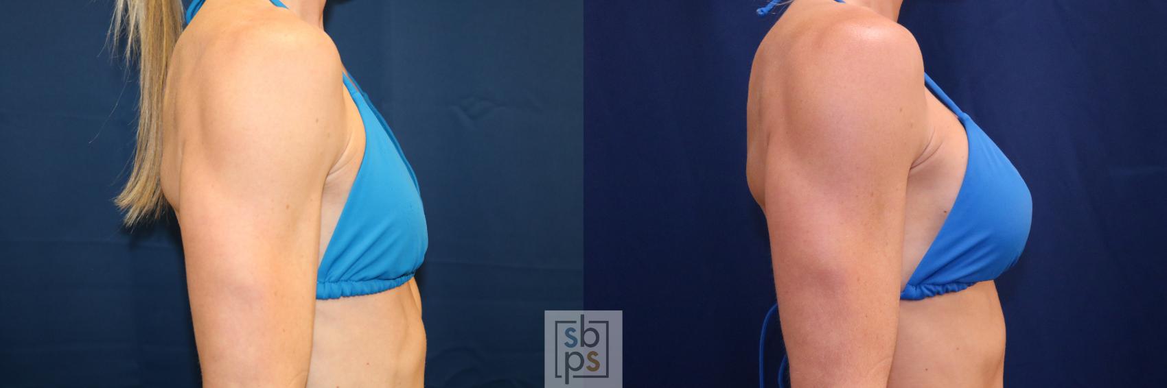 Before & After Breast Augmentation Case 688 Bikini Right View in Torrance & Los Angeles, CA, CA