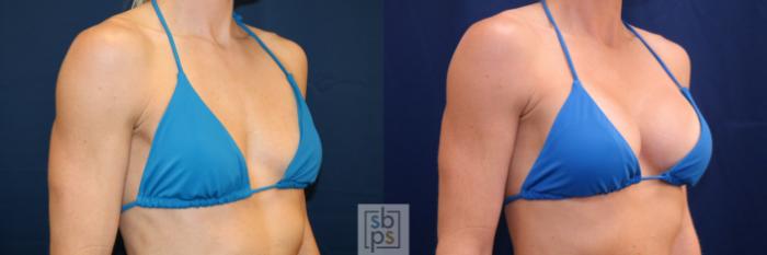 Before & After Breast Augmentation Case 688 Bikini Right Oblique View in Torrance, CA