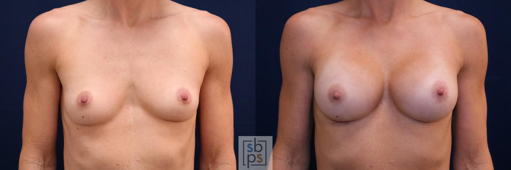 Before & After Breast Augmentation Case 688 Front View in Torrance, CA