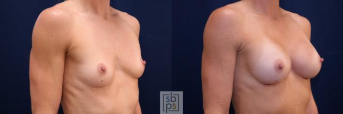 Before & After Breast Augmentation Case 688 Right Oblique View in Torrance, CA