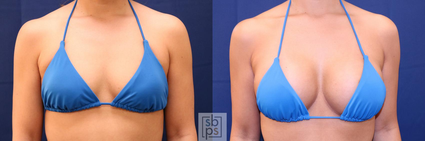 Before & After Breast Augmentation Case 701 Bikini Front View in Torrance & Los Angeles, CA, CA