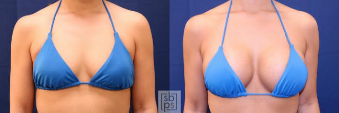 Before & After Breast Augmentation Case 701 Bikini Front View in Los Angeles & Torrance, CA, CA